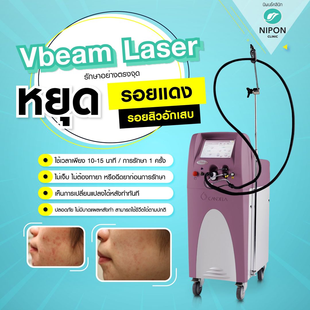 Vbeam Laser รักษาอย่างตรงจุด หยุด รอยแดง รอยสิวอักเสบ – Nipon Skin Clinic